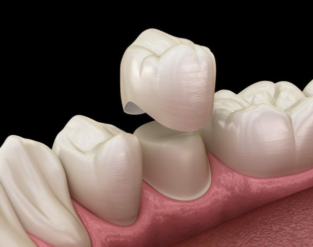 Bác sĩ sẽ tiến hành mài cùi răng thật sau đó bọc mão răng sứ giả bên ngoài.