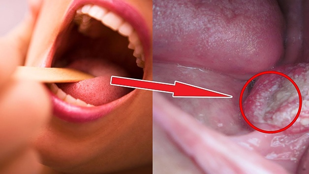 Hiện nay, có rất nhiều cách điều trị bệnh ung thư vòm họng