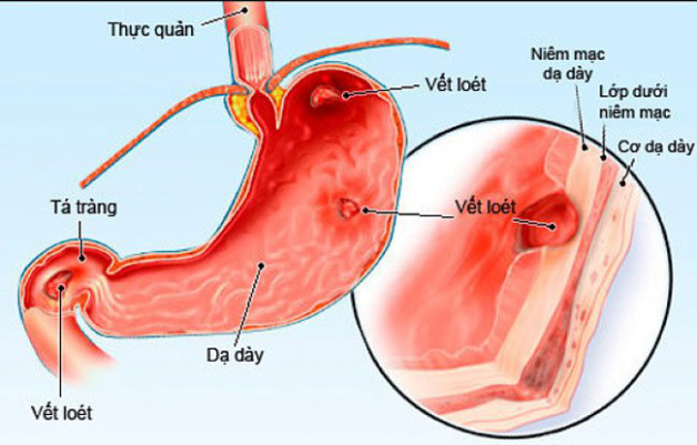 hình ảnh tiền ung thư dạ dày