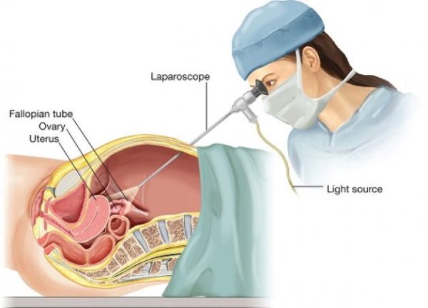 Tùy vào từng trường hợp, bác sĩ có thể chỉ định mổ nội soi hoặc mổ mở