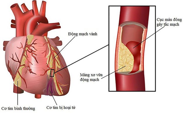 Chụp CT mạch vành cho phép bác sĩ phát hiện các bất thường hay bệnh lý về mạch vành
