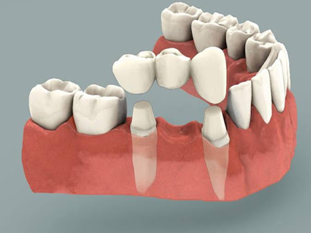 Cầu răng sứ là phương pháp phục hình cho người mất răng.