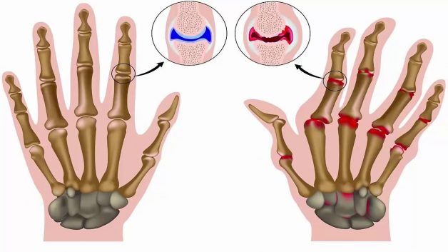 Biến chứng của các bệnh lý cơ xương khớp
