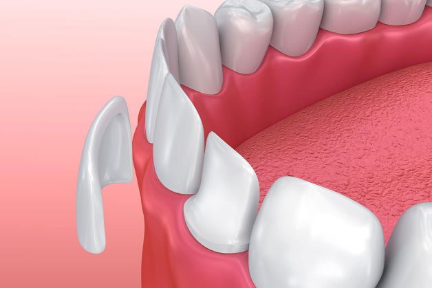 Dán sứ răng là gì? Là một phương pháp giúp cải thiện tính thẩm mỹ của hàm răng.