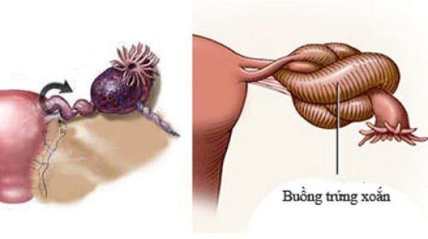 Điều trị u nang buồng xứng xoắn