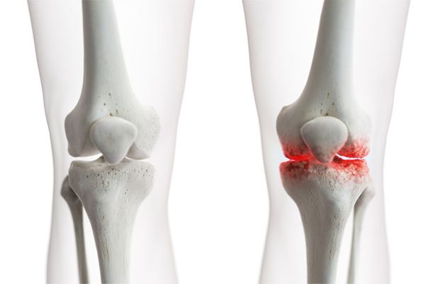 Khám thoái hóa khớp ở đâu tốt