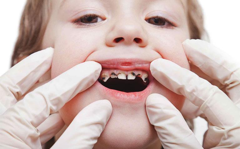 Sâu răng là tình trạng phổ biến ở trẻ