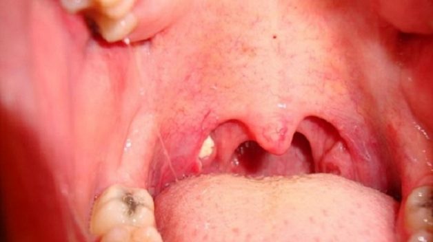 Giải đáp “Viêm họng mãn tính có chữa được không” sao cho đúng?