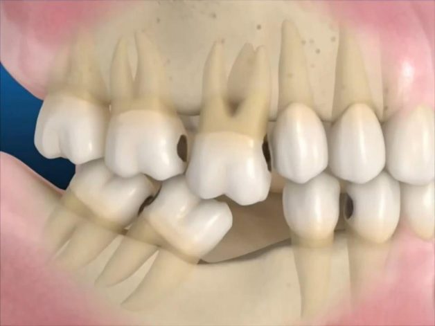 Răng khôn ảnh hưởng rất nhiều đến răng số 7, thậm chí còn khiến răng số 7 bị rụng, khiến cho cung hàm lệch và mất thẩm mỹ