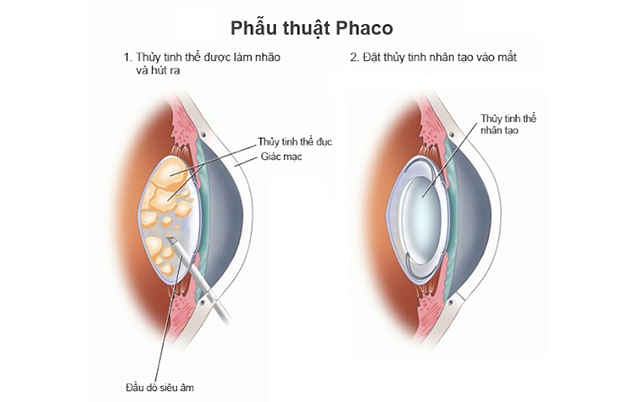 Phần lớn, người bệnh đục thuỷ tinh thể đều được bác sĩ khuyên là thực hiện phẫu thuật bằng phương pháp Phaco (Phacoemulsification).