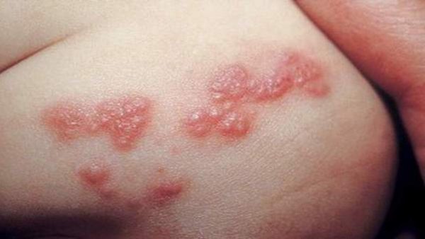 Mụn rộp sinh dục có nguy hiểm không?