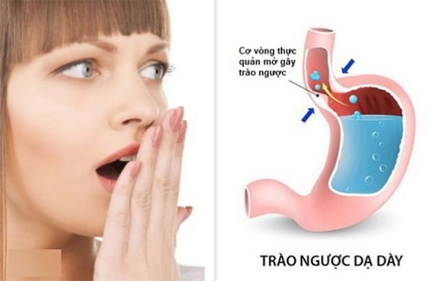 Bệnh trào ngược dạ dày- thực quản là nguyên nhân hôi miệng phổ biến.