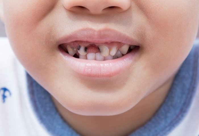 Khi bé bị sâu răng sữa quá nhiều không thể trám răng, sâu cụt tới chân răng thì cần tới nha sĩ để nhổ bỏ hoàn toàn