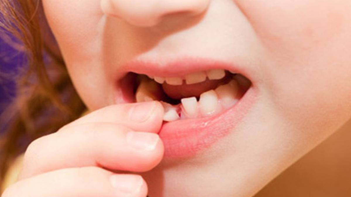 Nhổ răng sữa cho bé đúng thời điểm thay răng sữa sẽ giúp răng vĩnh viễn mọc đúng vị trí