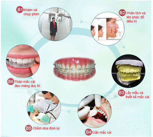 Quy trình niềng răng chỉnh nha là một quá trình phức tạp và đòi hỏi khá nhiều thời gian.