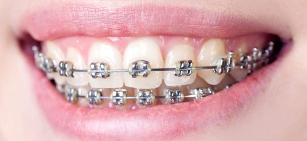 Niềng răng là phương pháp thẩm mỹ răng phổ biến và mang lại hiệu quả cao