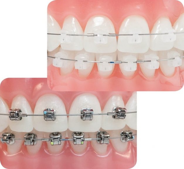 Với phương pháp niềng răng mặt ngoài, người bệnh có thể chọn mắc cài được làm bằng kim loại hoặc sứ