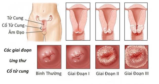 hình ảnh ung thư cổ tử cung