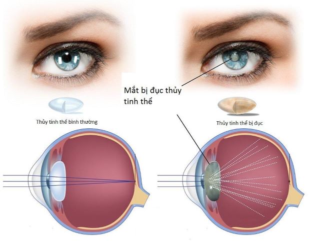 Thủy tinh thể là thấu kính trong suốt và nằm ở bên trong con mắt, có tác dụng hội tụ ánh sáng lên võng mạc và giúp lọc tia tử ngoại trong ánh nắng mặt trời.