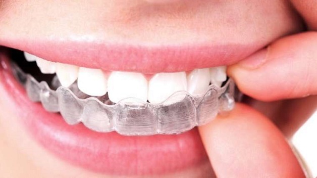 Tẩy trắng răng bằng máng thuốc