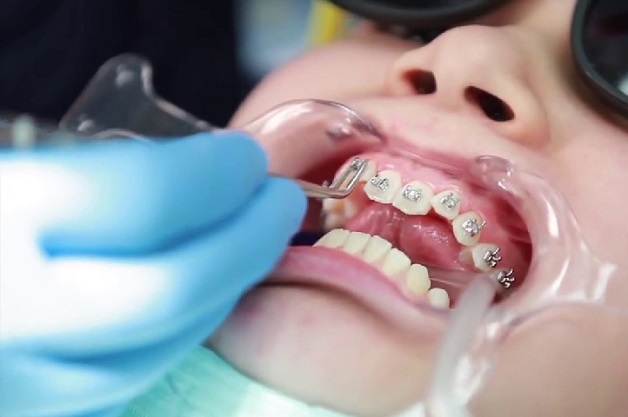 Đặt mắc cài là bước quan trọng trong quá trình niềng răng