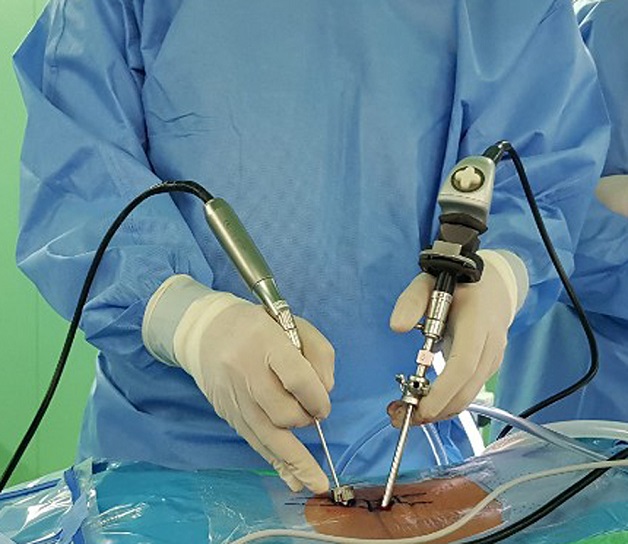 Hiện nay có 3 phương pháp nội soi được sử dụng rộng rãi