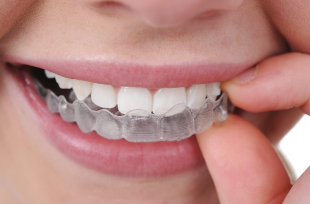 Sau khi có khay tẩy trắng riêng, chúng ta có thể thực hiện quy trình tẩy trắng răng ngay tại nhà.