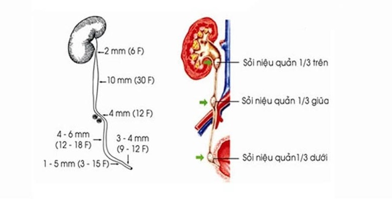 Sỏi niệu quản 1/3 giữa điều trị ra sao