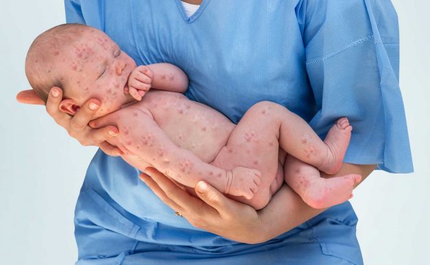 Sốt phát ban ở trẻ sơ sinh là bệnh tương đối thường gặp ở trẻ từ 5 đến 36 tháng tuổi. Đây cũng là điều dễ hiểu vì thời gian này sức đề kháng của trẻ còn yếu