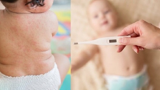 Sốt và nổi nốt phát ban là triệu chứng thường gặp khi trẻ nhỏ bị sốt phát ban