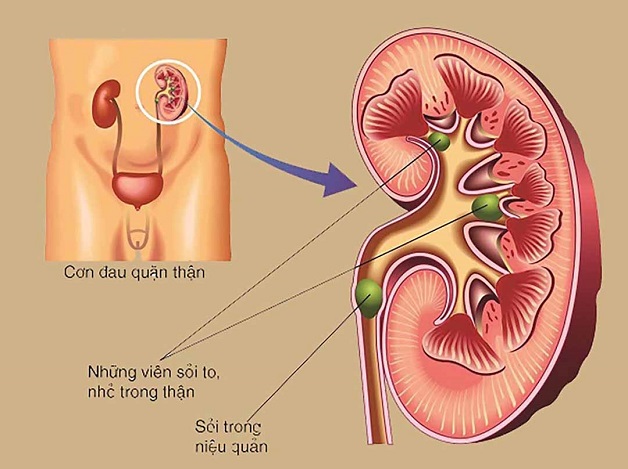 Tán sỏi niệu quản ngoài cơ thể áp dụng cho