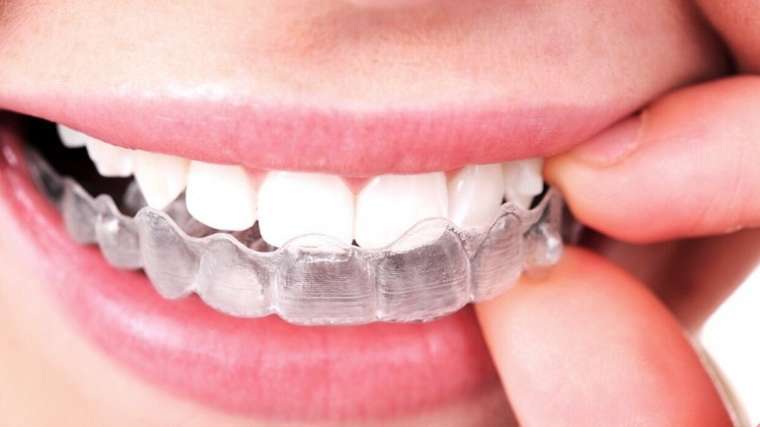 Tẩy trắng răng bằng máng là phương pháp tẩy trắng răng được nhiều người lựa chọn