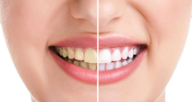 Sau quá trình tẩy trắng, chăm sóc răng miệng là điều quan trọng để răng được trắng sáng và khỏe mạnh