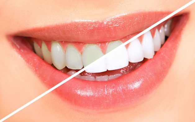 Tẩy trắng răng khắc phục được nhược điểm của răng, giúp người dùng tự tin với hàm răng trắng sáng