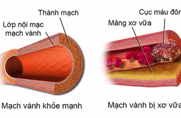 Tình trạng thiếu máu não có thể là do bệnh lý xơ vữa động mạch