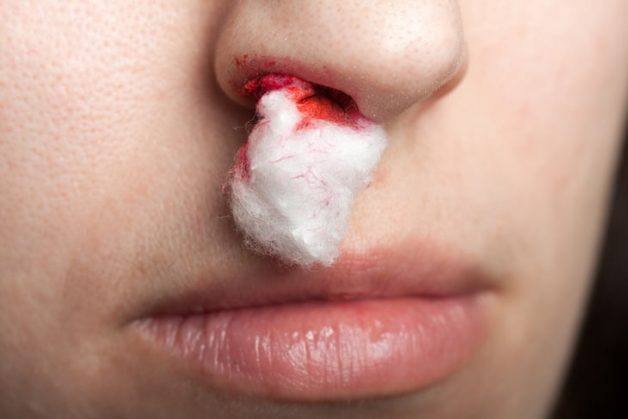 Dấu hiệu của ung thư vòm họng
