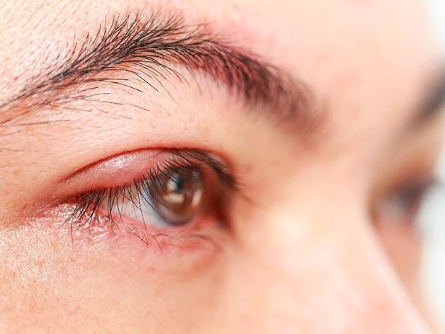 Biểu hiện của viêm kết mạc là mắt của người bệnh sẽ phù ở chân mi kèm theo các triệu chứng đi kèm như: ho, hắt hơi, sổ mũi, viêm họng và hạch