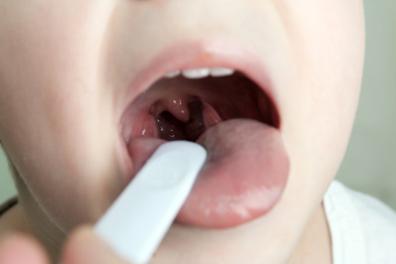 Amidan sưng to là dấu hiệu điển hình khi trẻ em bị viêm amidan