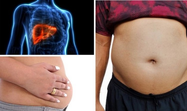 Điều trị ung thư gan giai đoạn cuối - cổ trướng