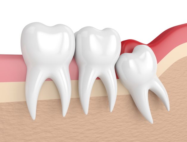 Trường hợp giữa răng số 7 và răng khôn có khe giắt thì cần phải nhổ răng khôn để tránh tạo điều kiện cho cho vi khuẩn phát triển giữa khe hở 2 răng