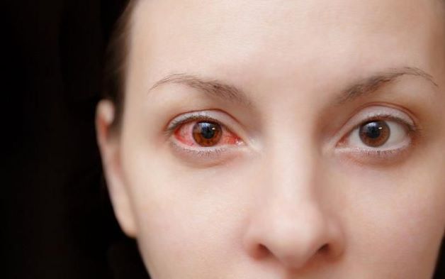 viêm kết mạc mắt có nguy hiểm không ạ