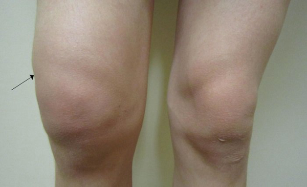 biểu hiện của tràn dịch khớp gối