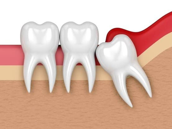 TÌnh trạng viêm lợi trùm cần được điều tra nội nha đến khi viêm ổn định mới có thể tiến hành nhổ răng khôn