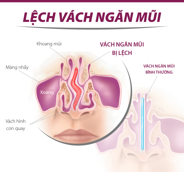 lệch vách ngăn mũi