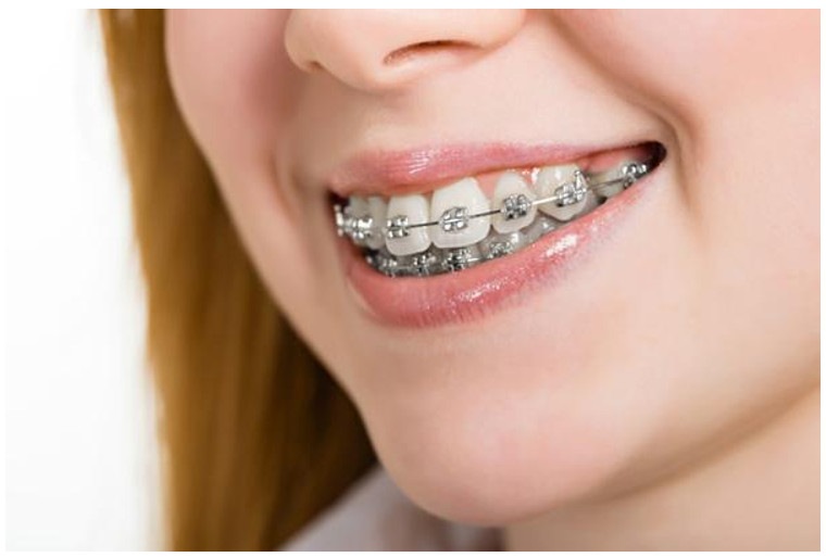 Sau 50 tuổi, niềng răng không phát huy hiệu quả