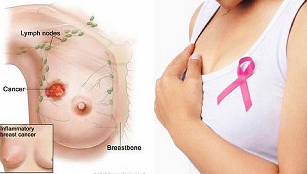 địa chỉ điều trị ung thư vú tốt