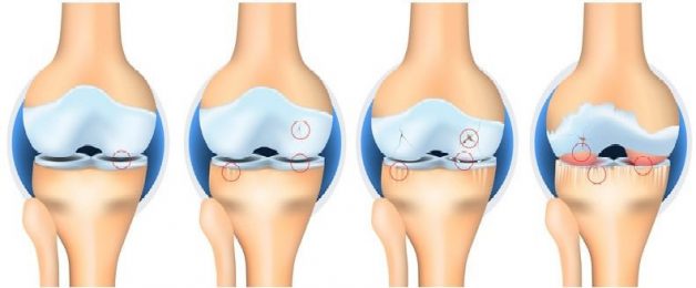 Ý nghĩa của vận động trong điều trị thoái hóa khớp gối
