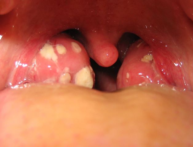 Viêm amidan hốc mủ là dạng viêm amidan mãn tính, bệnh gây ảnh hưởng nghiêm trọng đến đời sống sinh hoạt và sức khỏe của người bệnh
