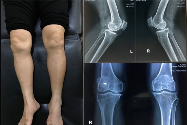 bị thoái hóa khớp gối