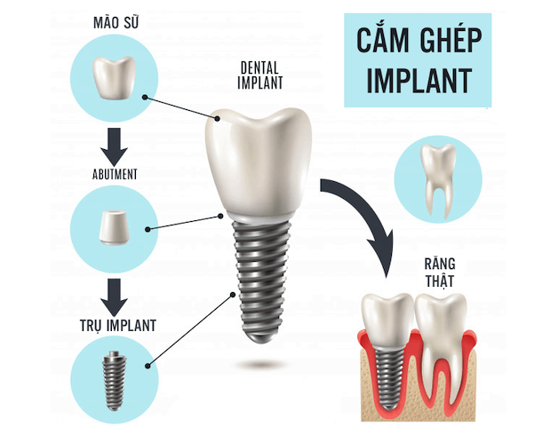 Trồng răng implant được đánh giá là giải pháp tối ưu cho hầu hết các trường hợp mất răng.